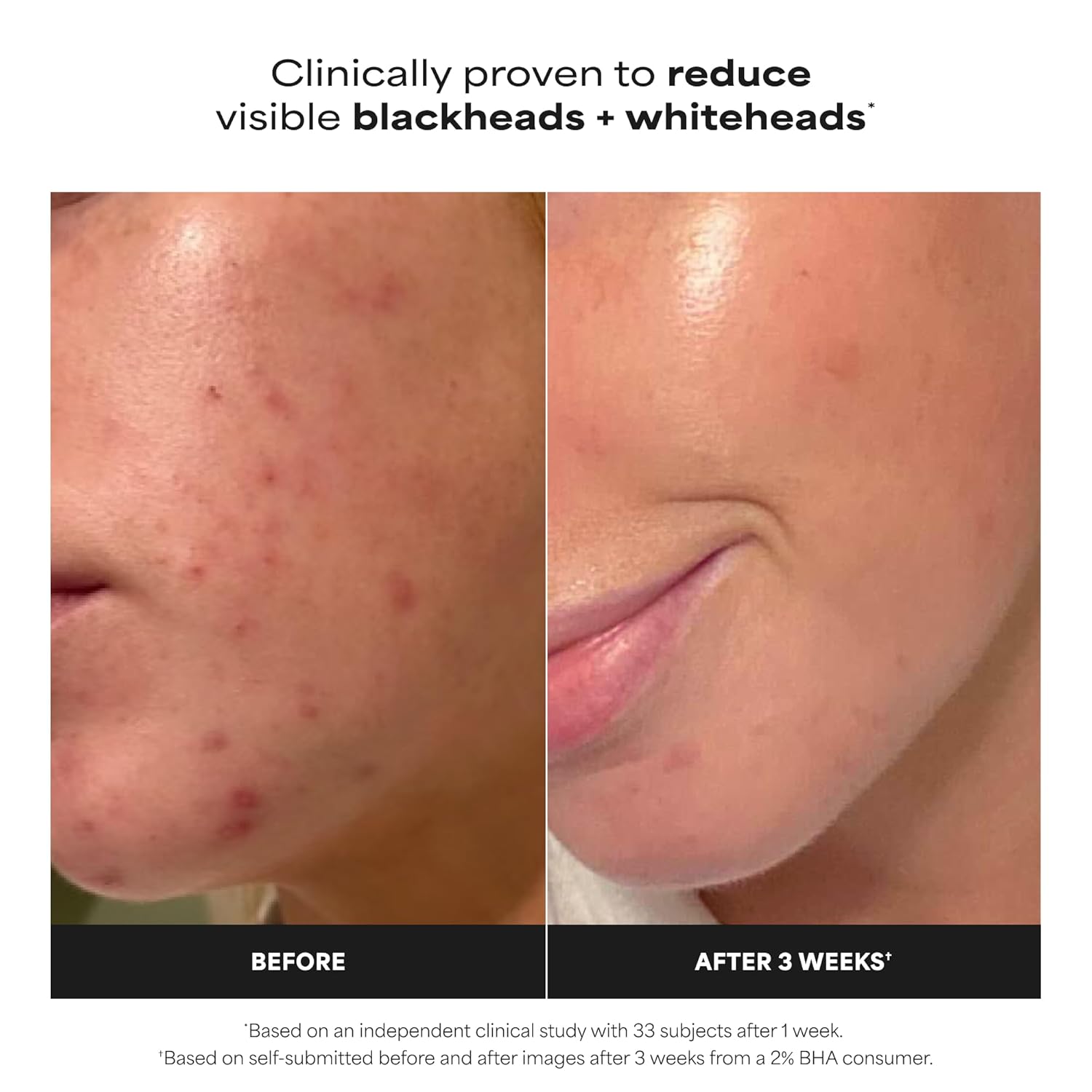 Paula's Choice SKIN PERFECTING 2% BHA Liquid Exfoliant
