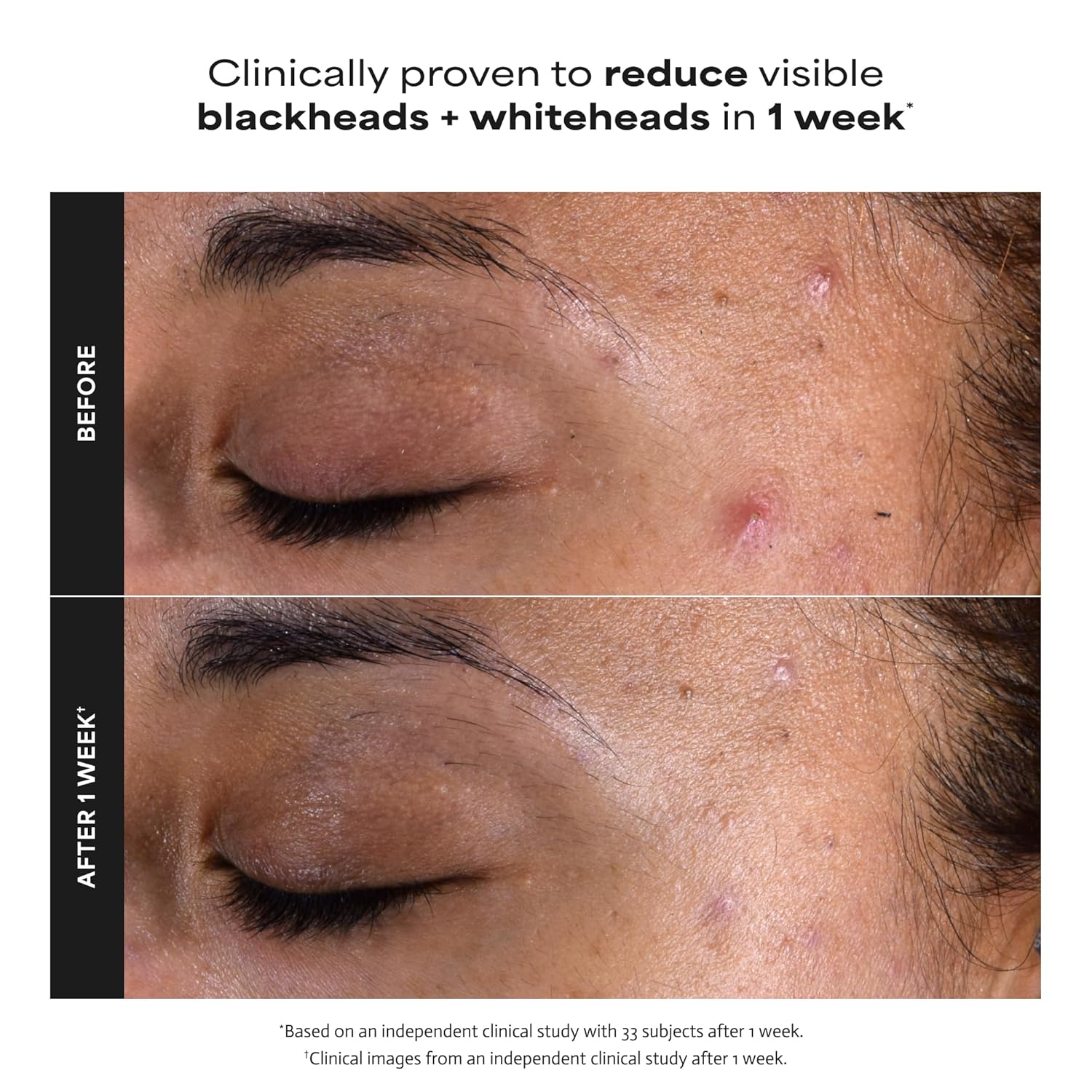 Paula's Choice SKIN PERFECTING 2% BHA Liquid Exfoliant